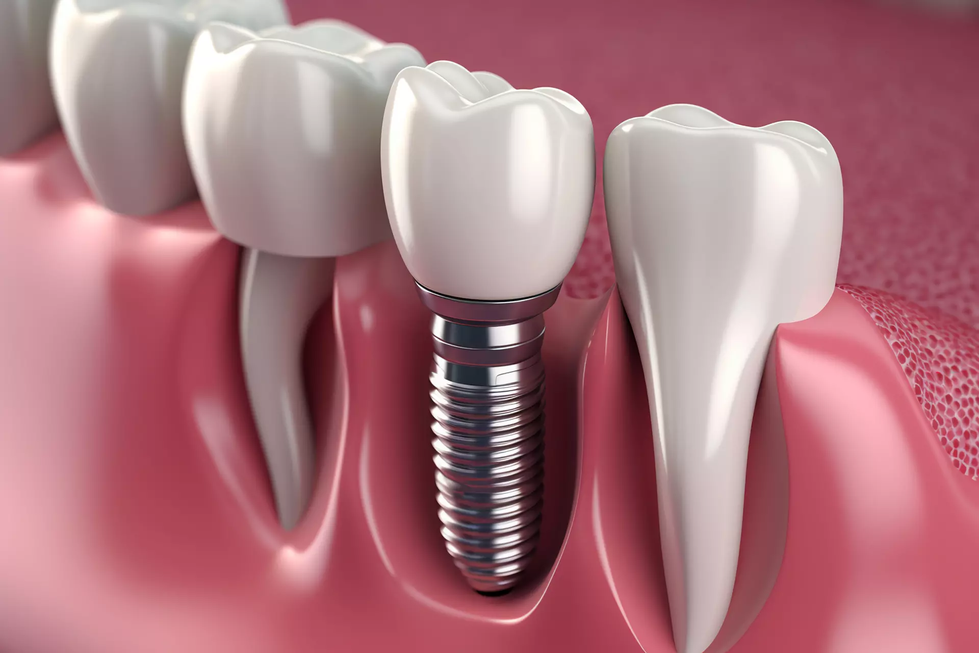Dental implants in Skokie IL - CityView Family Dentistry