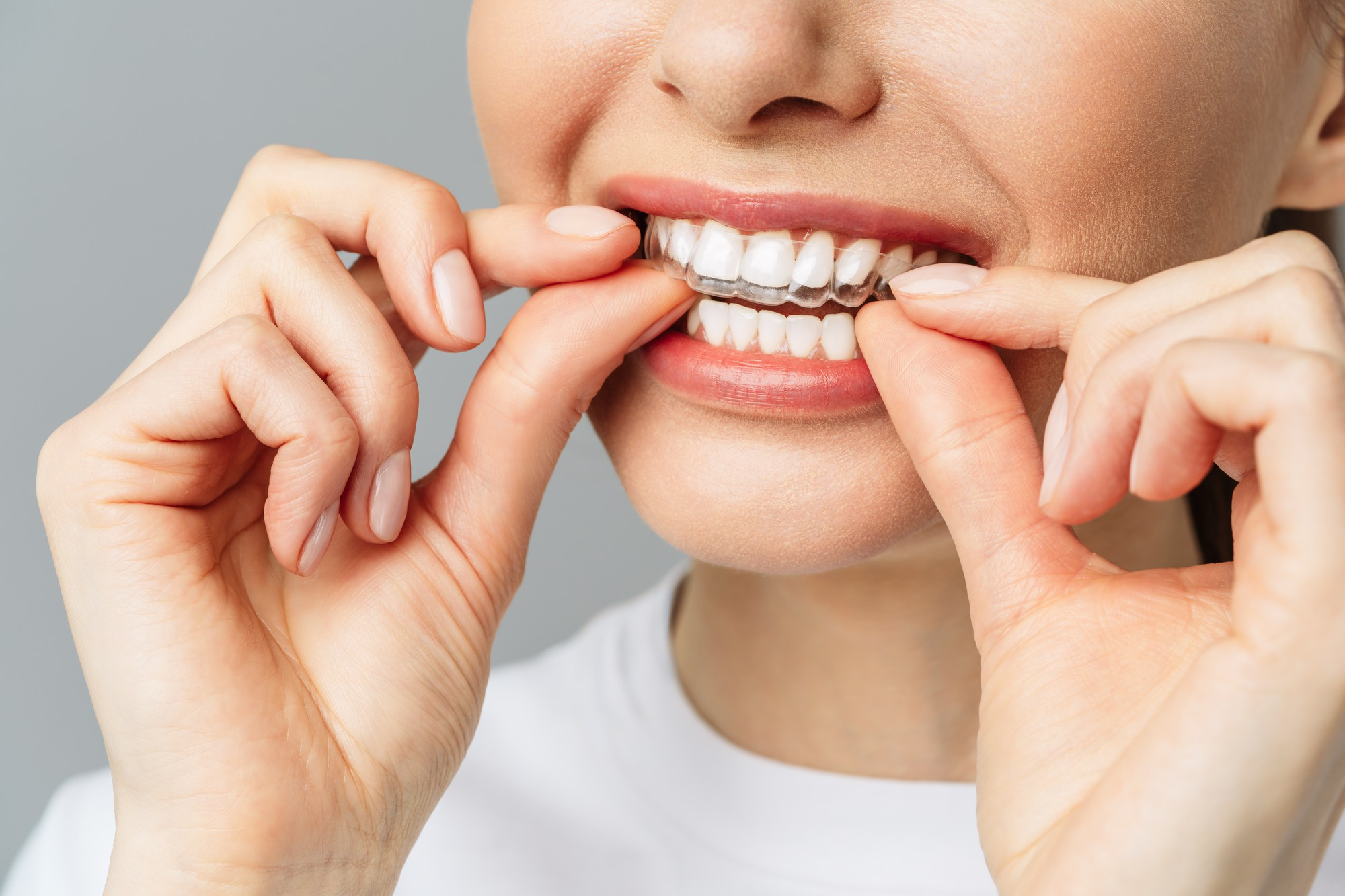 Invisalign clear aligners Skokie IL - CityView Family Dentistry